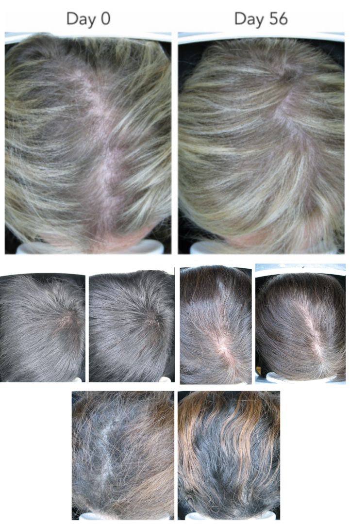 Hair Growth Progress